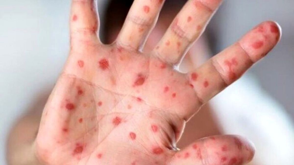 اعلام وضعیت اضطراری در نیویورک به دلیل شیوع سرخک